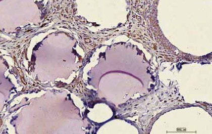 SAMPLE OF TISSUE INJECTED WITH BIOMTERIALS