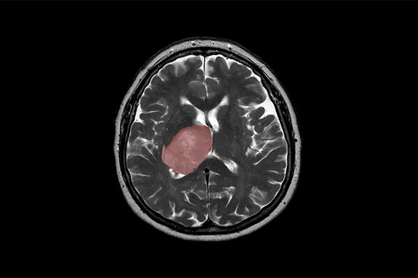 scan of a brain tumour