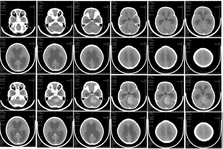 A brain scan of child with medulloblastoma