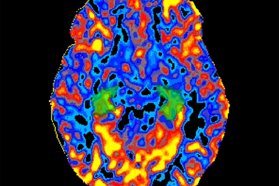 brain mri