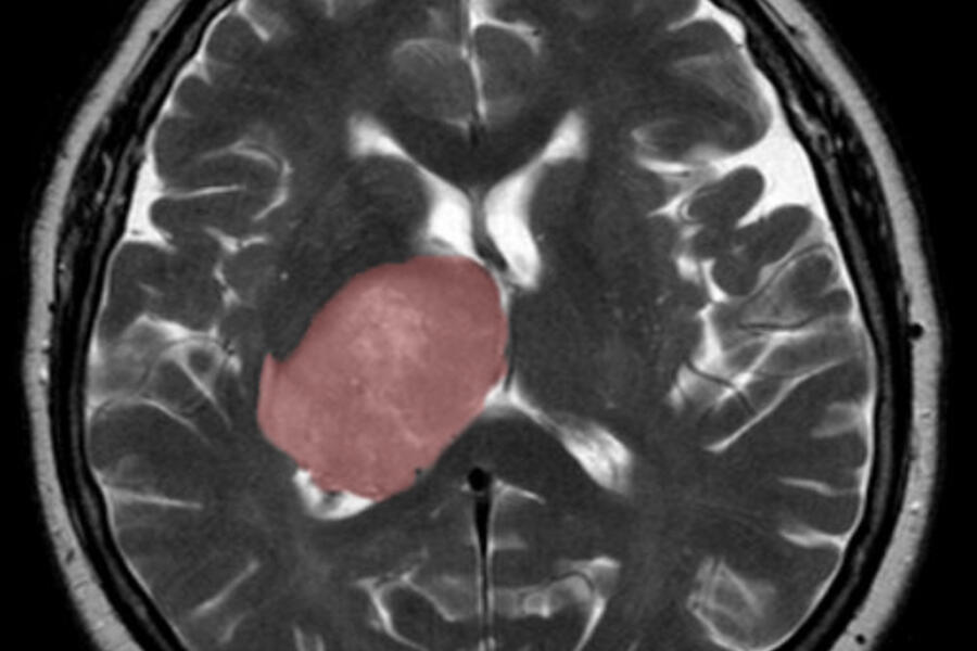 scan of a brain tumour