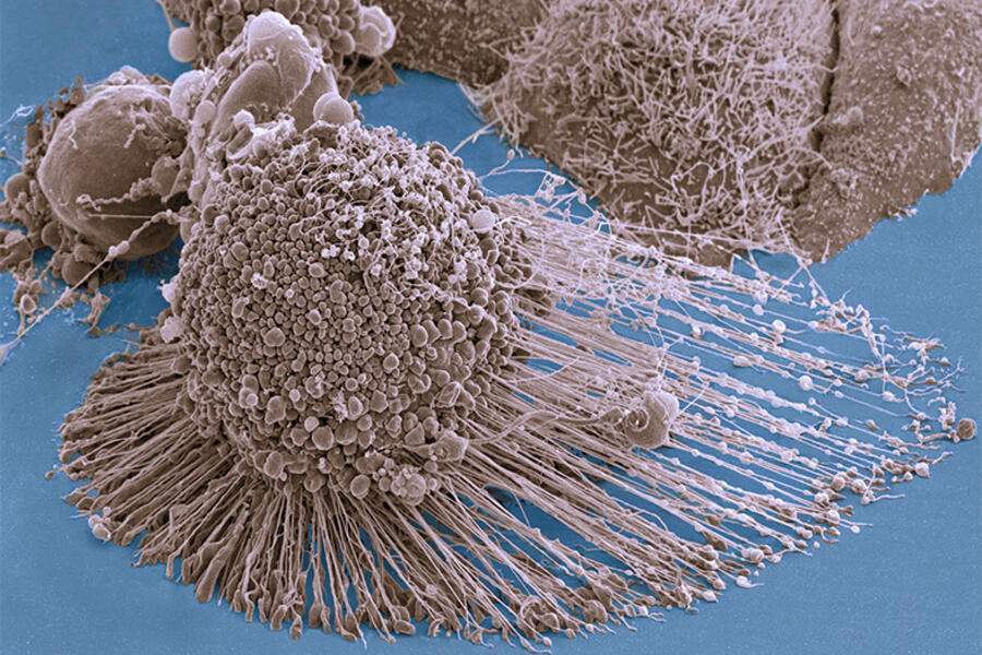 cancer cells