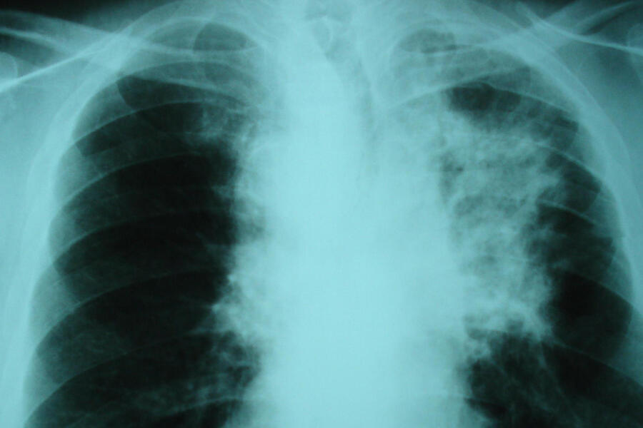 chest x ray