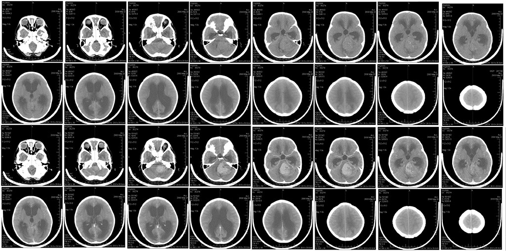 A brain scan of child with medulloblastoma
