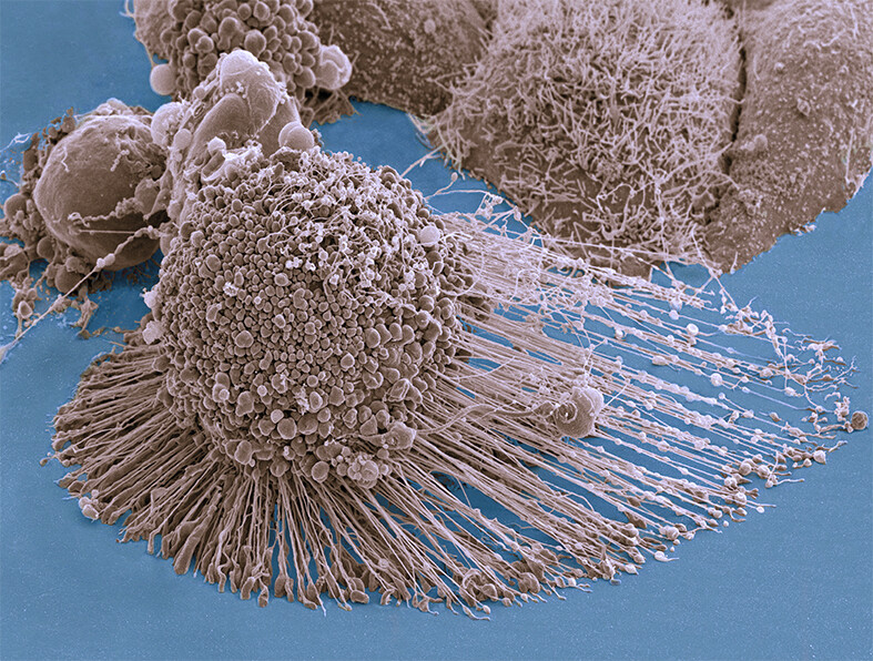 Dietary change starves cancer cells, overcoming treatment