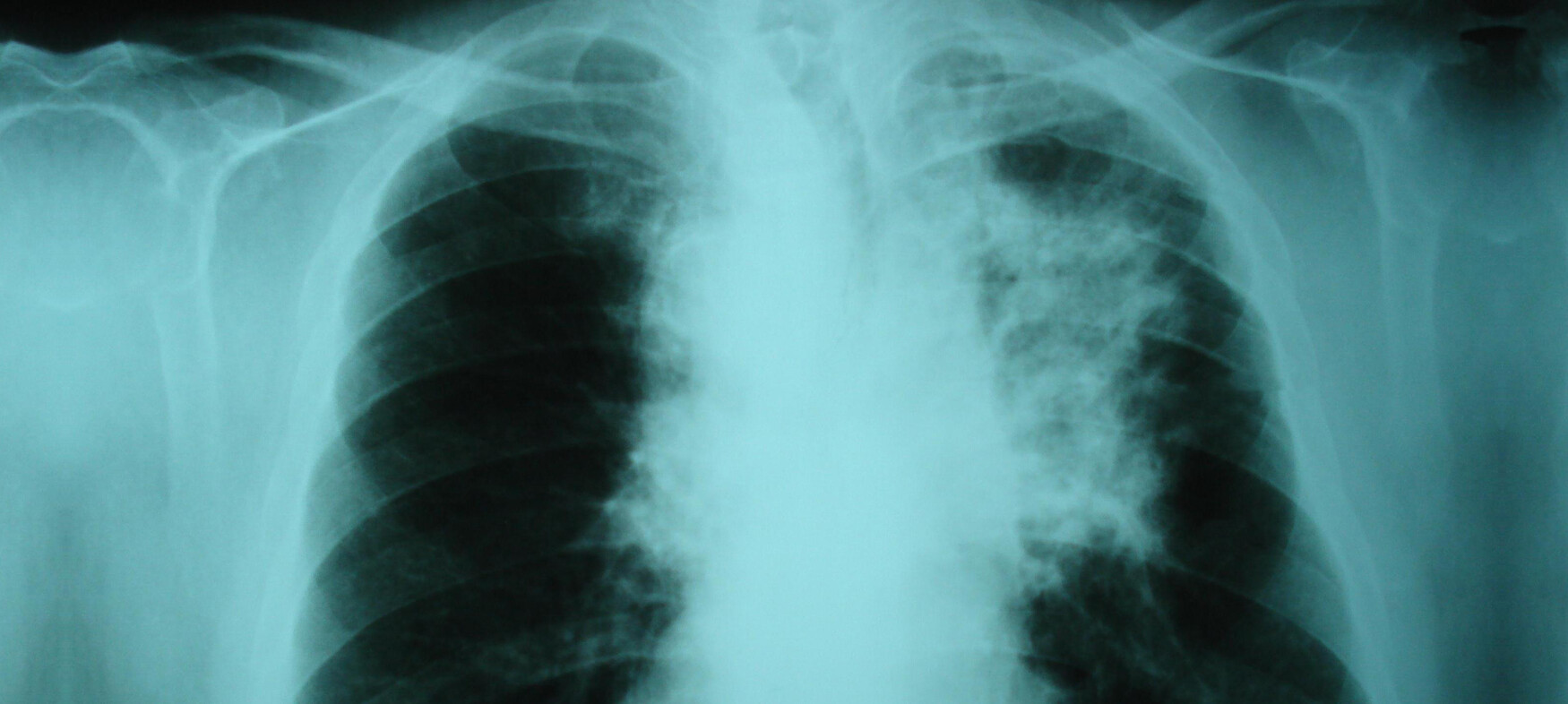 chest x ray